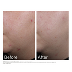 UV Clear Blemish-Prone & Oil Balancing SPF50