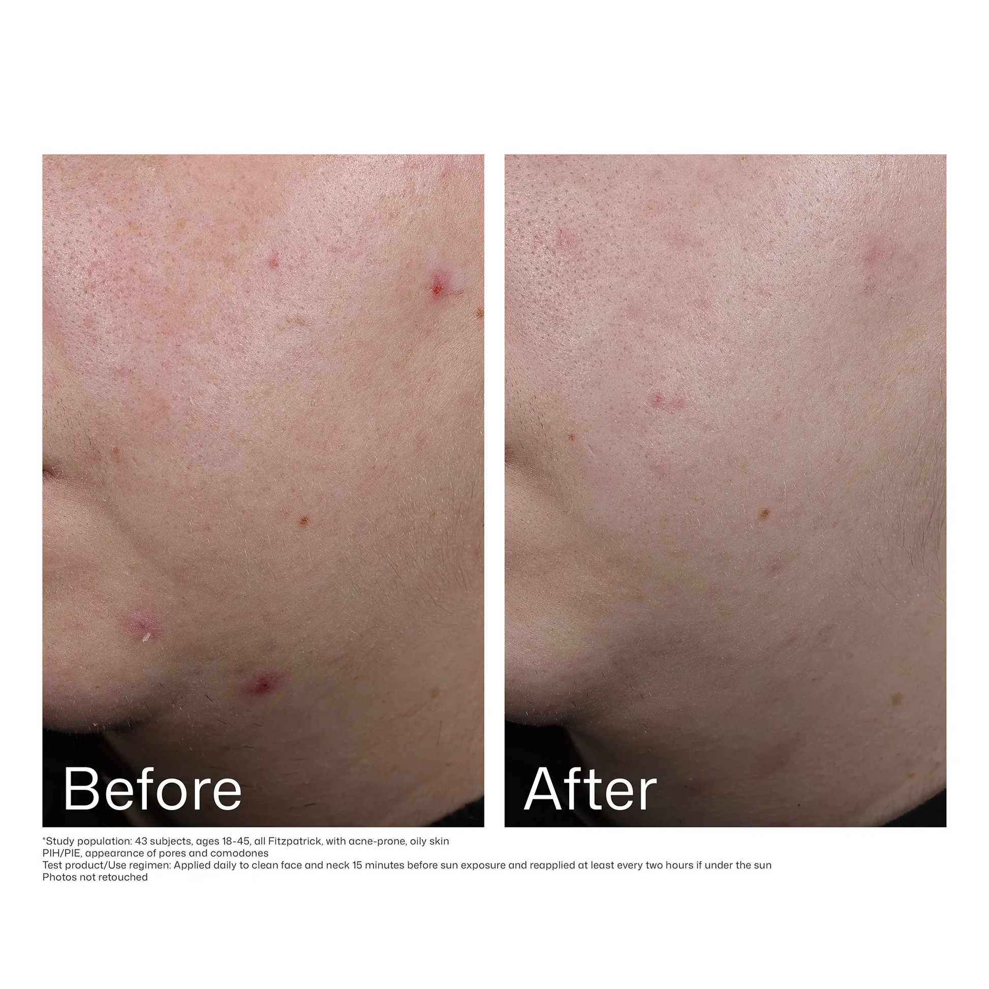 UV Clear Blemish-Prone & Oil Balancing SPF50