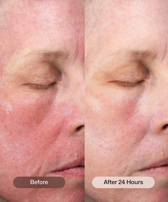 CMT Post-Procedure Cream